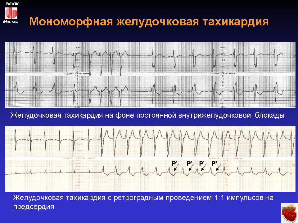 Презентация на тему: Желудочковая экстрасистола (VE), инициирующая ...