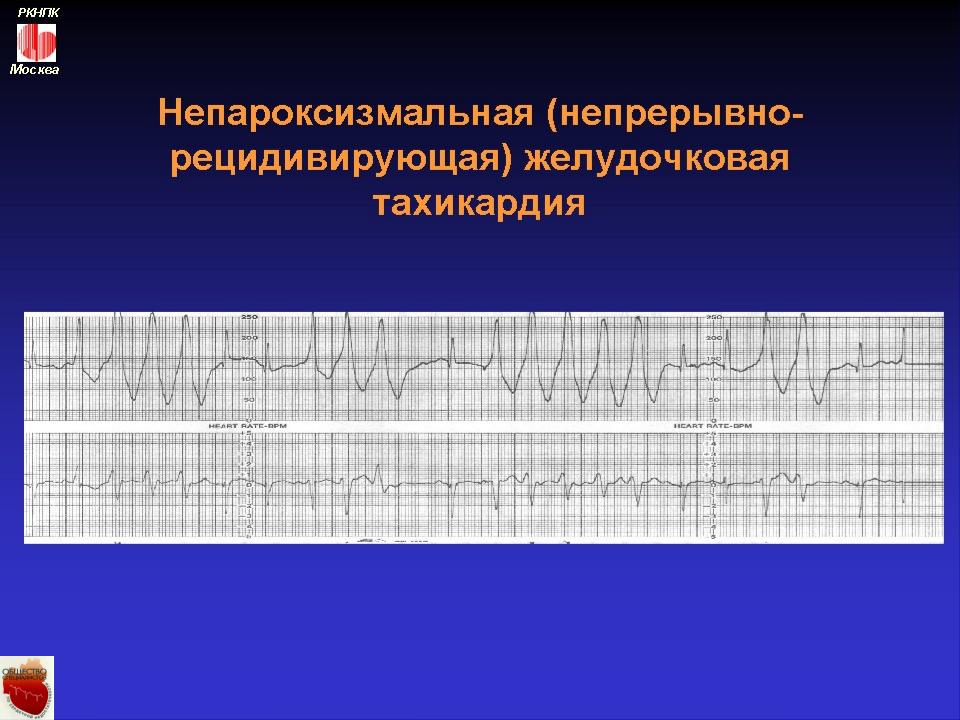 Желудочковая тахикардия карта вызова скорой медицинской