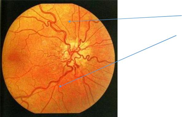 Сужение сосудов глаз. Гипертоническая ангиопатия и ретинопатия. Гипертоническая ангиопатия сосудов. Гипертоническая ангиопатия сетчатки. Гипертоническая ретинопатия Салюс.