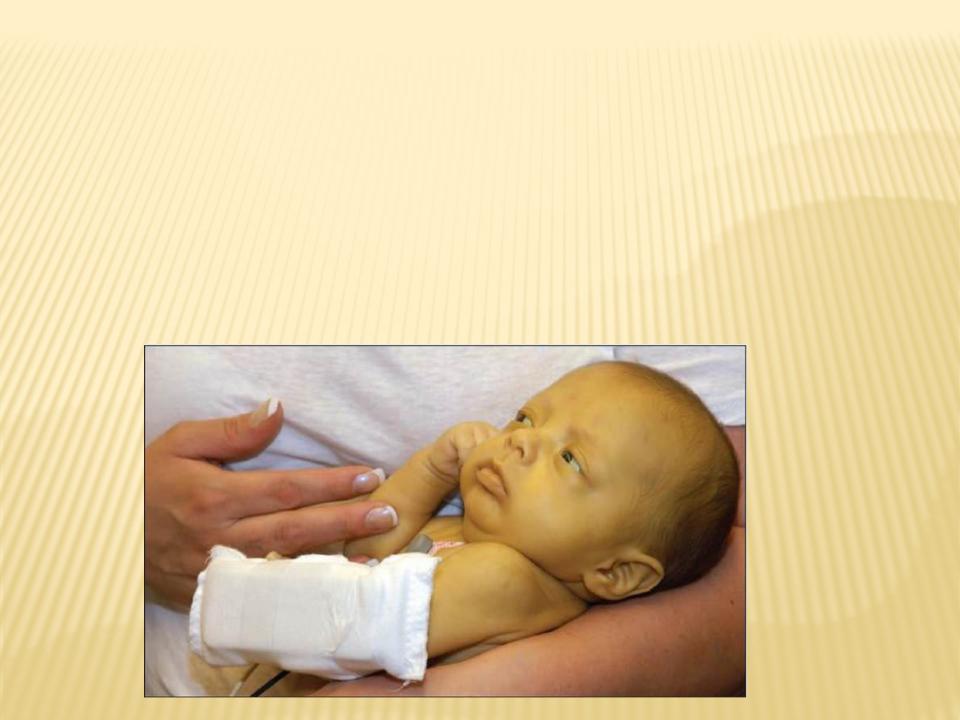 Желтуха симптомы у детей. Гемолитическая болезнь новорожденных гемолитическая анемия. Гемолитическая желтуха новорожденных. Новорожденный отечная форма ГБН. Гемолитическая анемия желтуха.