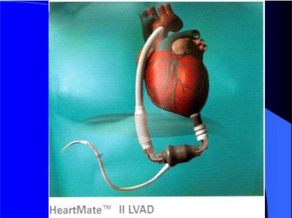 Сколько весит искусственный левый желудочек. Искусственный левый желудочек сердца. Искусственное сердце аппарат. Искусственное сердце человека.