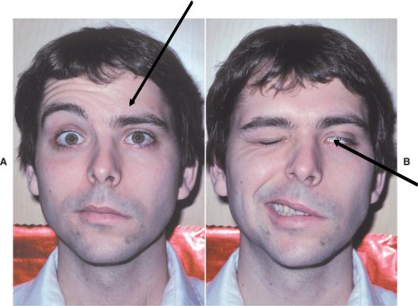 Лицевой нерв после операции. Асимметрия лица. Искривление лицевого нерва.