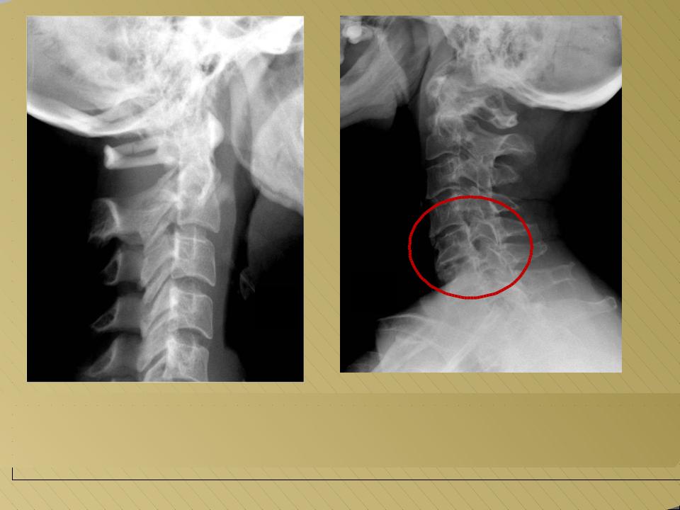Мр картина нарушения статики шейного отдела