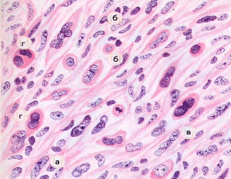 Единичные митозы. Фибросаркома препарат патанатомия. Эпителиоидная саркома гистология. Трофобластическая опухоль микропрепарат. Фибросаркома гистология.