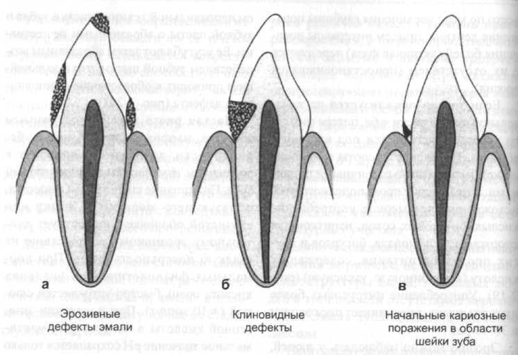 Клиновидный дефект стоматологическая карта