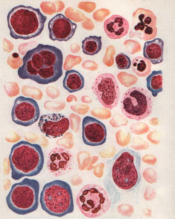 Кровь на б клетки. Костный мозг при б12 дефицитной анемии. В12 дефицитная анемия кровь. Б12 дефицитная анемия картина крови. Б12 анемия костный мозг.