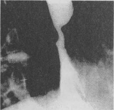Короткий пищевод. Рефлюкс эзофагит на рентгенограмме. Рентген при рефлюкс эзофагите. Эрозивный эзофагит пищевода рентгенограмма.