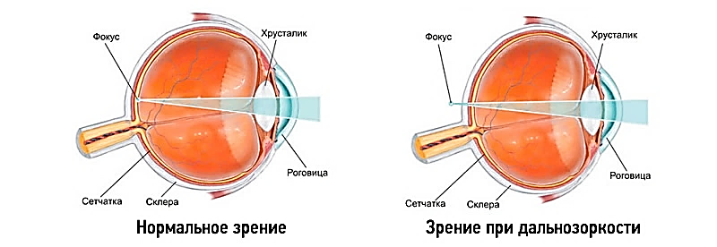 К оптической системе глаза относятся роговица хрусталик. Нарушение зрения. Глаз при гиперметропии. Дальнозоркость глаз. Хрусталик при дальнозоркости.
