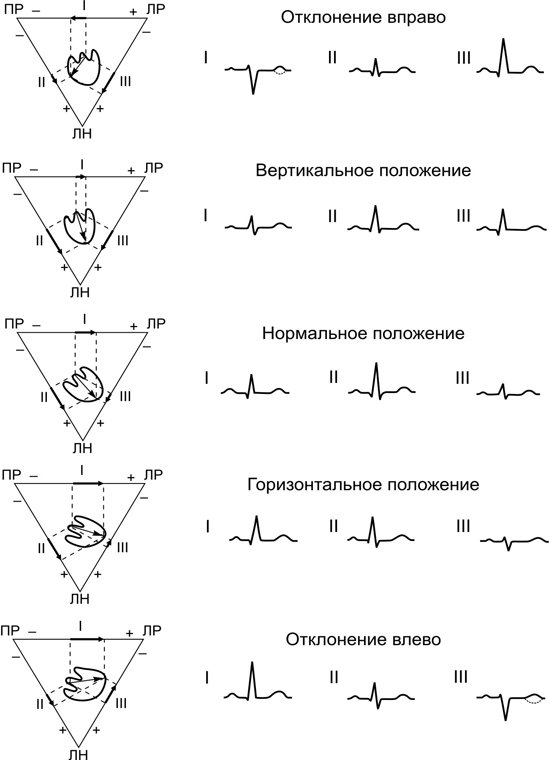 Определение осей сердца