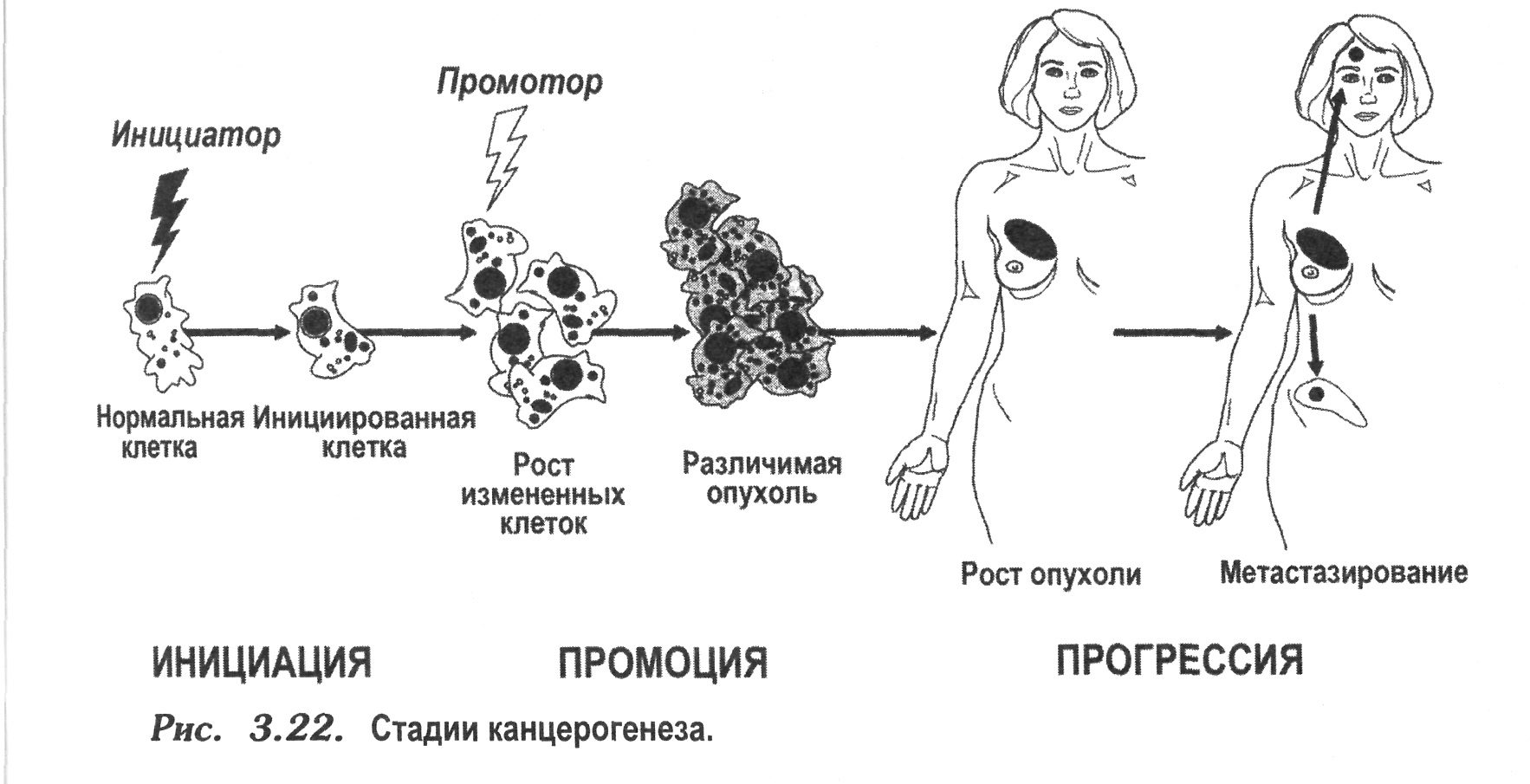 Процесс формирования опухоли