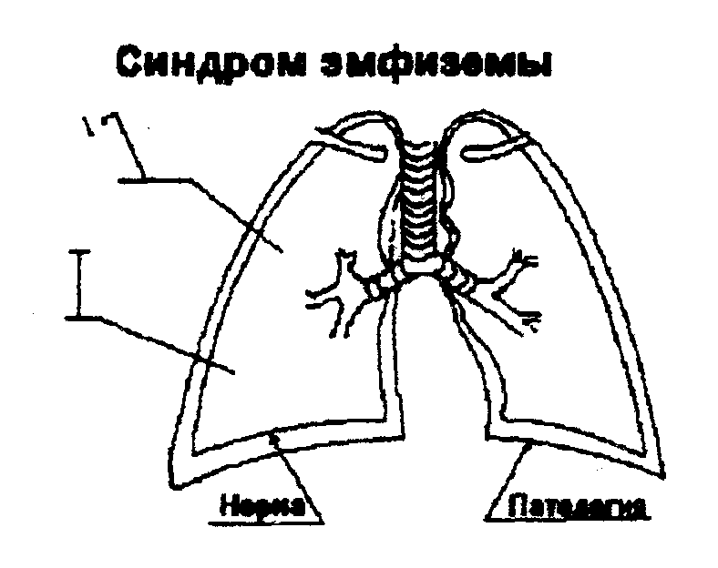 Синдром полости в легком сообщающейся с бронхом thumbnail