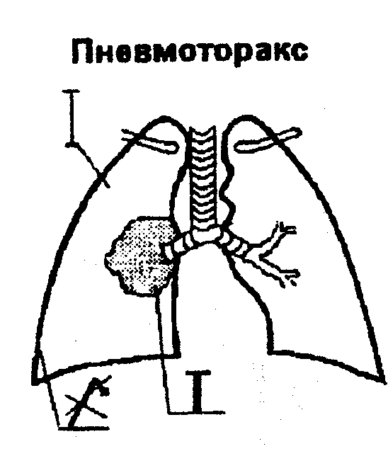 Спонтанный пневмоторакс карта вызова смп