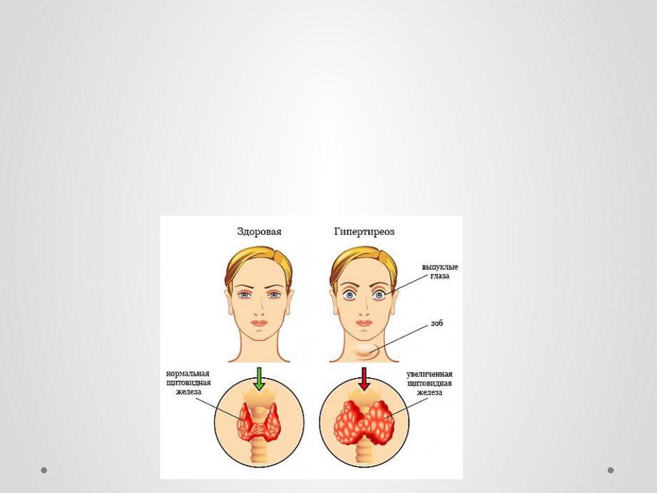 Гипотиреоз на фоне. Гипертиреоз щитовидной железы симптомы у детей. Гипо гипертиреоз щитовидной железы. Тиреотоксикоз щитовидной железы симптомы у мужчин. УЗИ щитовидной железы гипертиреоз.