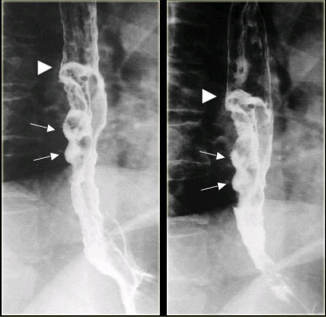 Рентген пищевода. Экзофитные опухоли пищевода. Опухоль пищевода рентген. Дисфагия пищевода рентген.
