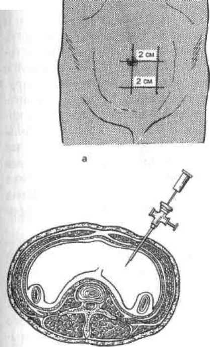 Операция лапароцентез