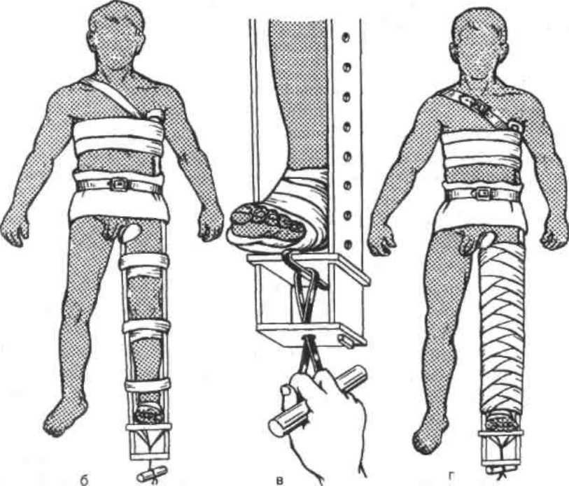 Транспортная иммобилизация нижней конечности