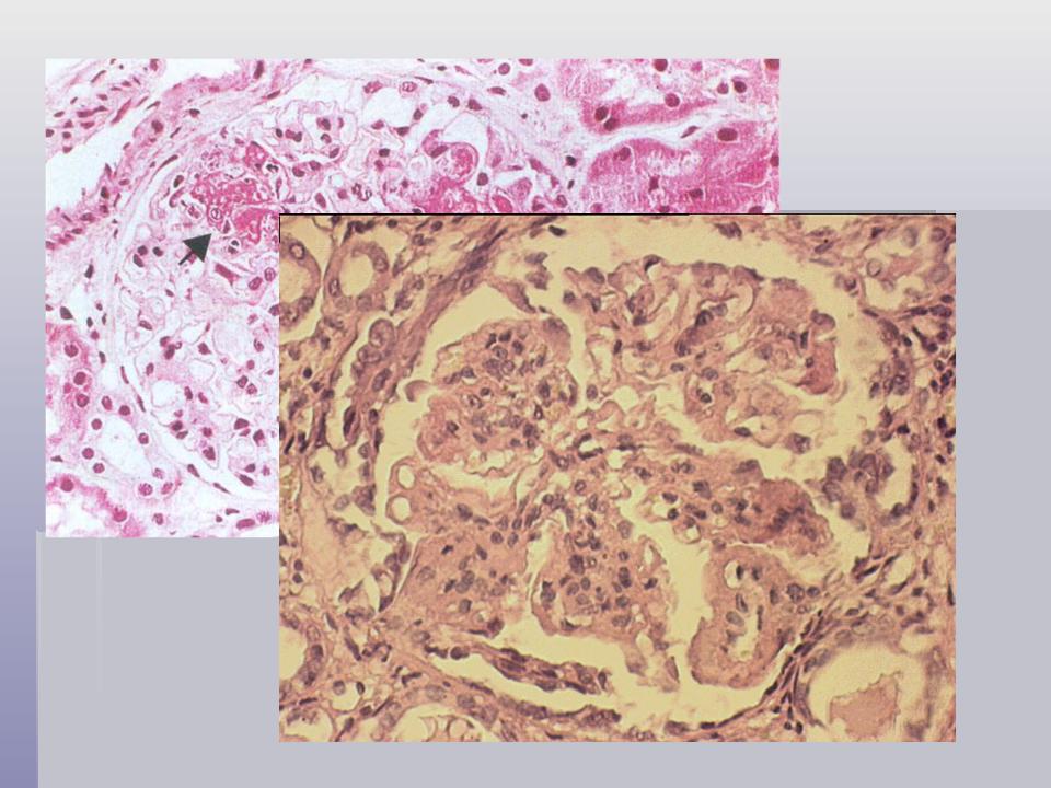 Ревматическое заболевание соединительной ткани. Системная красная волчанка (коллагеноз). Коллагеноз соединительной ткани фото.