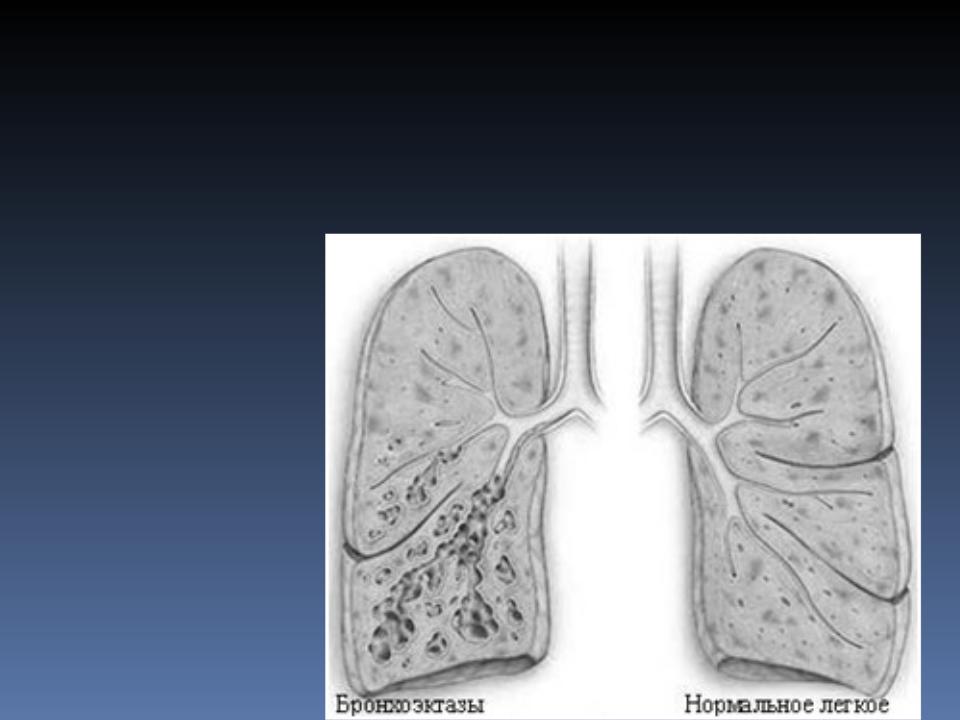Рентген картина бронхоэктазов