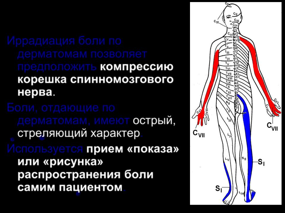 Иррадиация боли в ногу. Синдром компрессии корешка s1. Синдром компрессии s1 корешка справа. Компрессии корешка l5 или s1. Иррадиация боли от позвоночника схема.