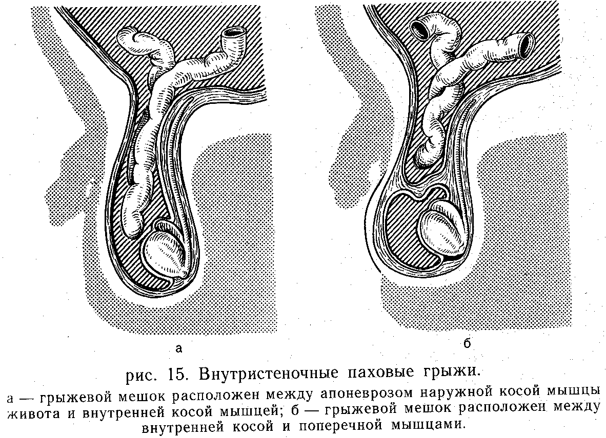 Хирургическая анатомия ущемленных врожденных и скользящих паховых грыж thumbnail