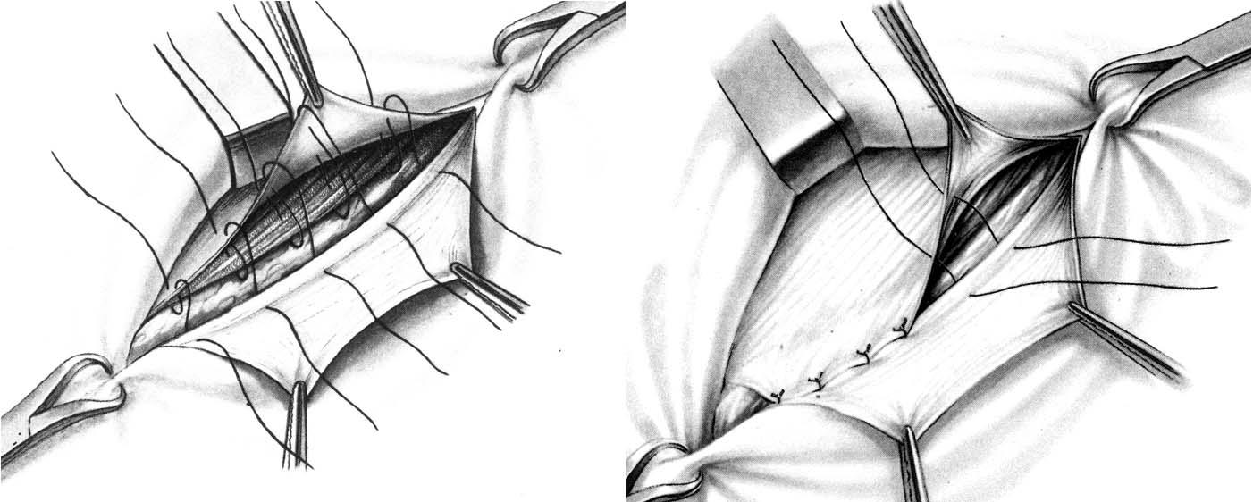 Техника операции грыжи брюшной стенки