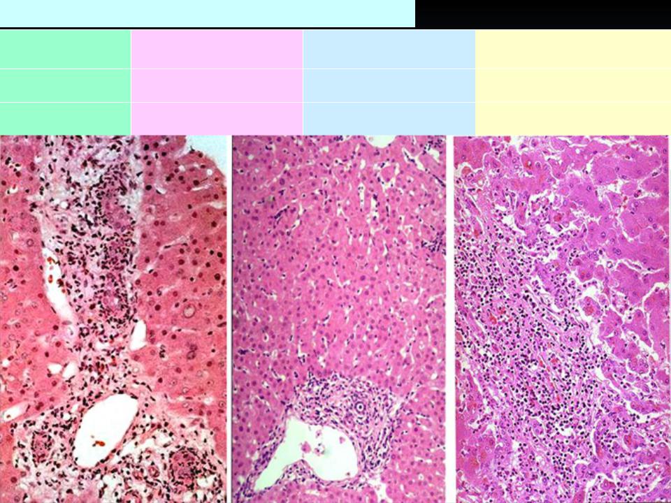 Вирусный гепатит печени. Холестатическая форма вирусного гепатита. Хронический гепатит патанатомия. Холестатический гепатит гистология. Хронический вирусный гепатит макропрепарат.