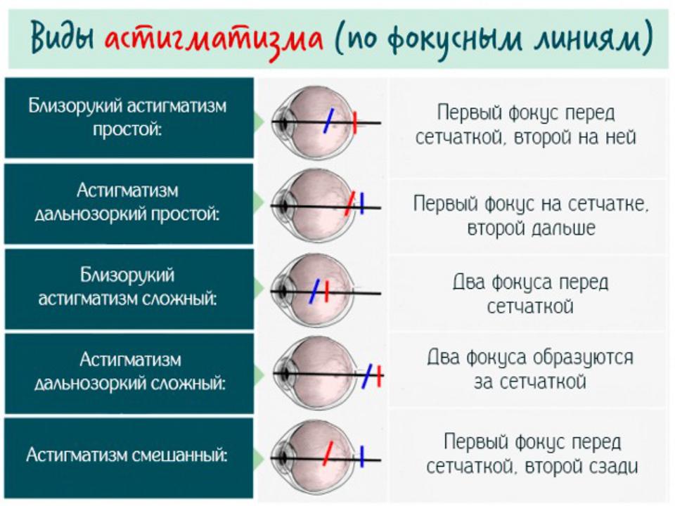 Глаз 0. Сложный гиперметропический астигматизм обоих глаз. Обратный миопический астигматизм. Сложный гиперметропический астигматизм у детей. Что такое сложный миопический астигматизм глаз.