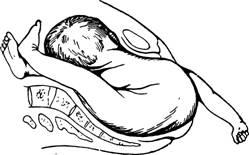 Самопроизвольные роды до 34 недель. Роды сдвоенным туловищем. Поперечное положение плода родоразрешение. Рождение сдвоенным телом плода.
