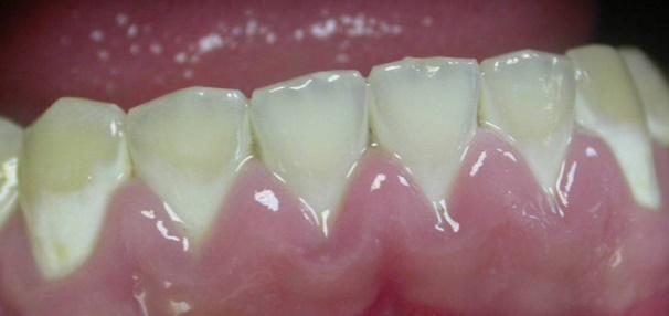 Деминерализация очаговая зубов лечение