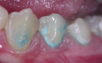 Очаговая деминерализация постоянных зубов лечение