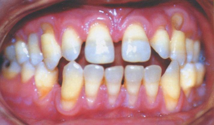 Некариозные поражения зубов возникающие после прорезывания лечение