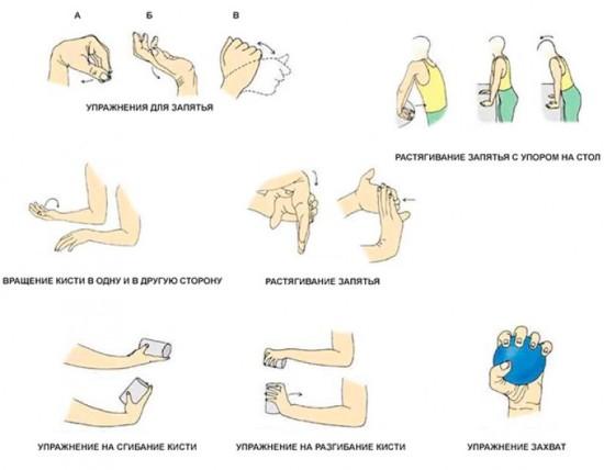 Комплекс упражнений после перелома лучевой кости руки