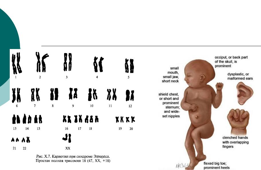 18 хромосома. Эдвардс синдром кариотип. Синдром Патау набор хромосом.