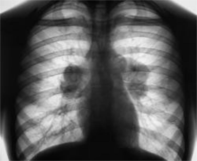 Легкие увеличен узел. Туберкулез внутригрудных лимфатических узлов рентген. Саркоидоз внутригрудных лимфоузлов рентген. Рентген лимфоузлов средостения. Лимфаденопатия внутригрудных лимфоузлов рентген.