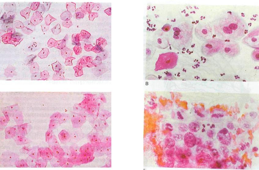 Атрофический кольпит у женщин после 60 лет. Бактериальный вагиноз микроскопия мазка. Плоский эпителий цитология. Урогенитальный кандидоз микроскопия.