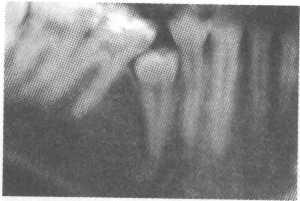 Аномалии формы и размера зубов лечение