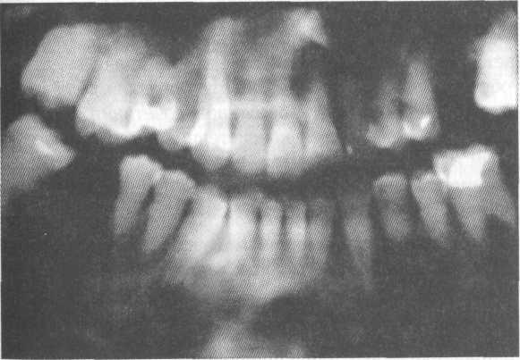 Мраморная болезнь зубов клиника диагностика лечение thumbnail