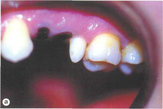 Аномалии формы и размера зубов лечение