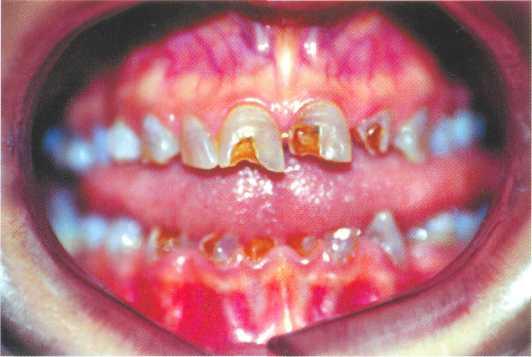Лечение при мраморной болезни зубов
