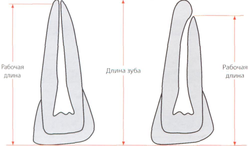 Определение корневых каналов. Рабочая длина корневого канала. Длина корневых каналов зубов. Измерение рабочей длины корневого канала. Измерение длины канала зуба.