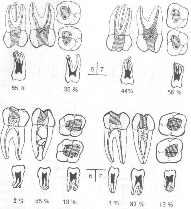 Сколько каналов в 16. 1 Моляр нижней челюсти анатомия корневых каналов. Анатомия корневого канала второй моляр верхней челюсти. Топография устьев корневых каналов зубов нижней челюсти. 1 Моляр нижней челюсти эндодонтия.