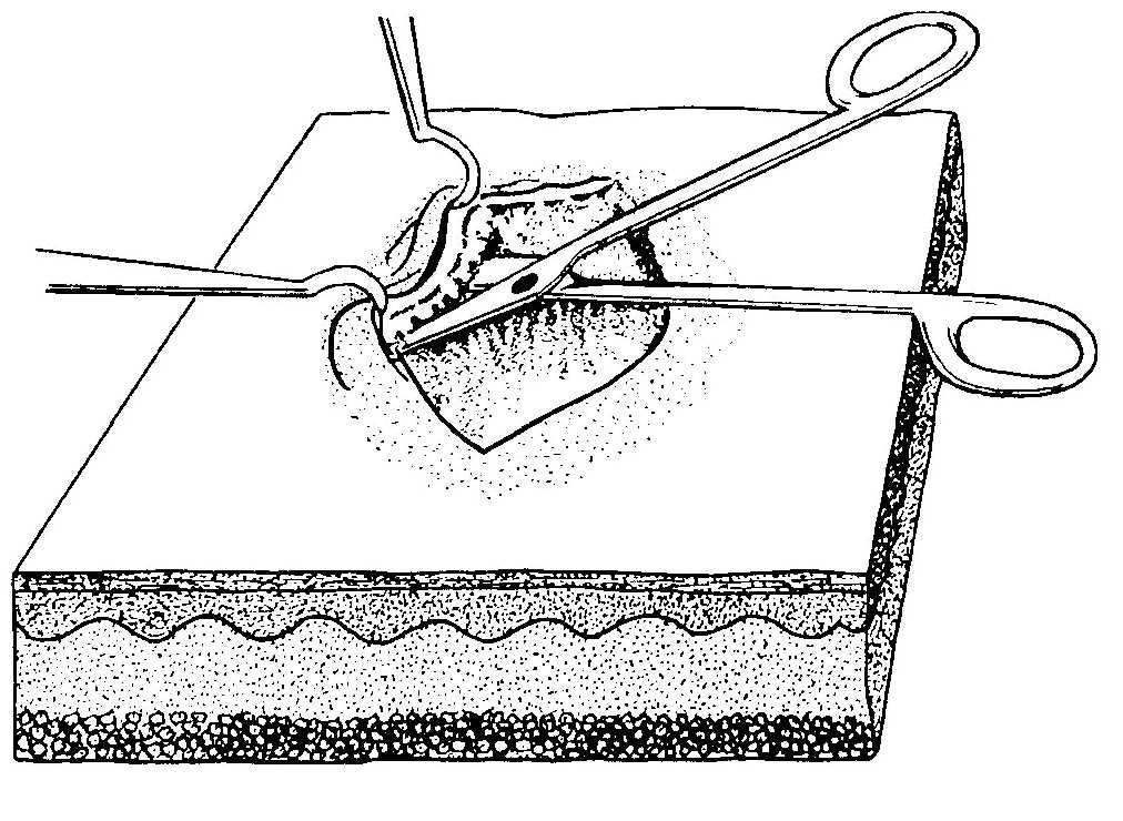 Иссечение краев дна и стенок раны с последующим наложением швов