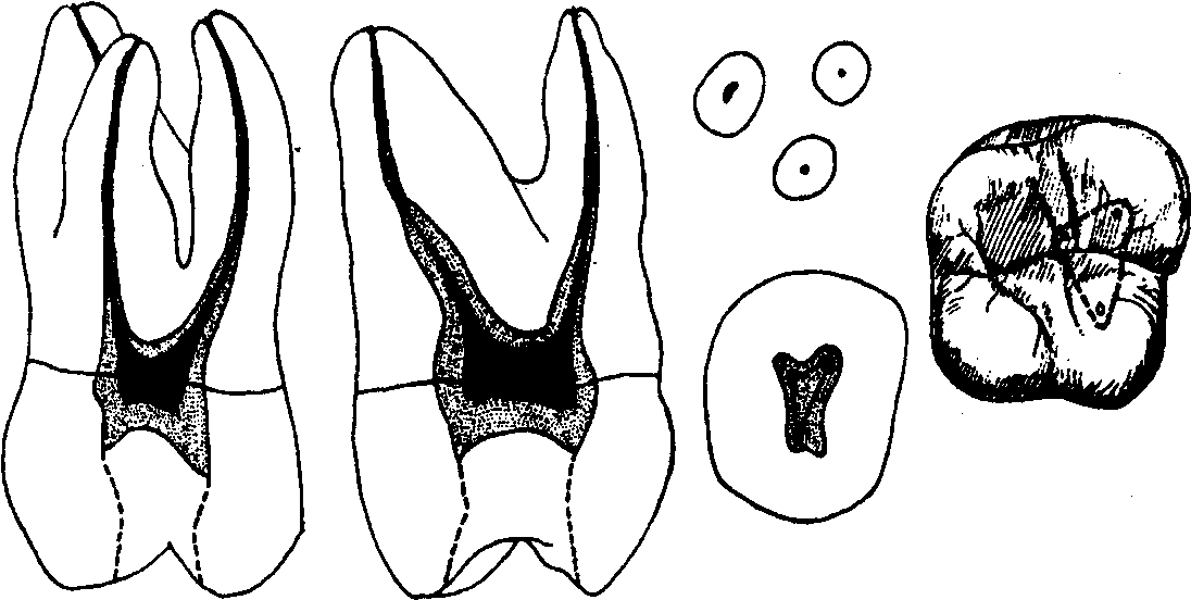 Первый верхний 2. Первый моляр верхней челюсти корни. 1 Моляр верхней челюсти анатомия. 2 Моляр верхней челюсти анатомия. Первый верхний моляр верхней челюсти.
