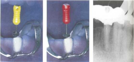 Степ бек техника в лечении зубов