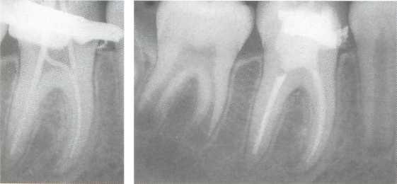 Лечение постоянных зубов с несформированными верхушками корней thumbnail