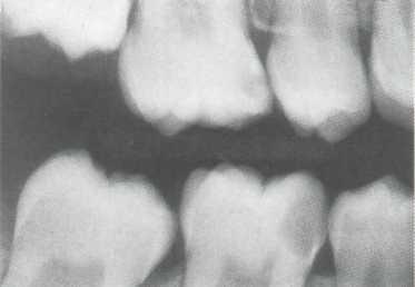 Лечение пульпита постоянного зуба с несформированной верхушкой