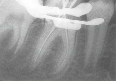 Лечение пульпита постоянного зуба с несформированной верхушкой