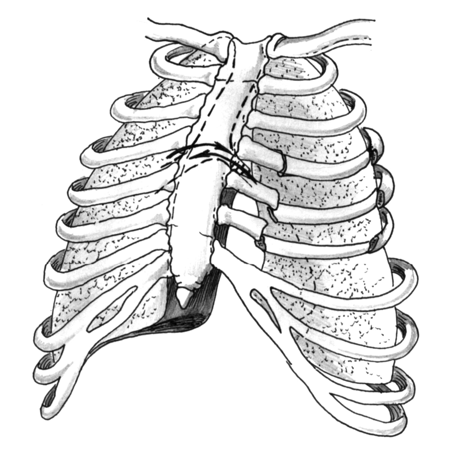 Могут ли ребра. Перелом ребер грудной клетки. Сегментарный перелом ребра. Перелом грудинного хряща ребра. Неосложненный перелом ребра.