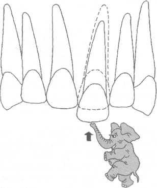 Смещение зубов при ортодонтическом лечение