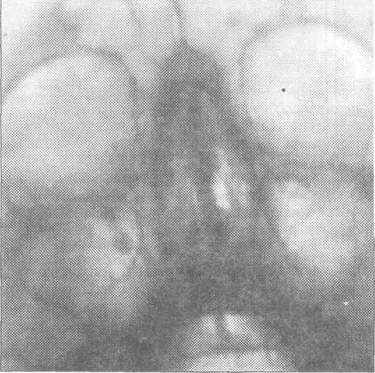 Отлом бугра верхней челюсти при удалении зуба лечение